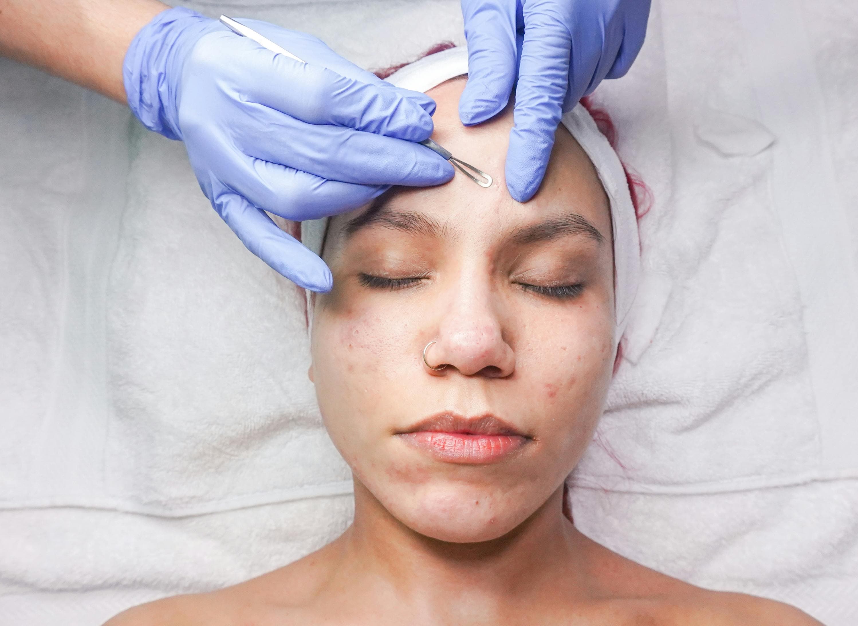 Tratamente pentru acnee în 2026: ce recomandă dermatologii români